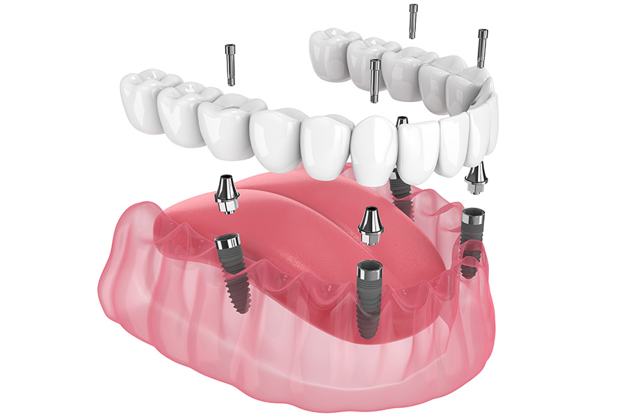 Jamacha Dental Special Offer