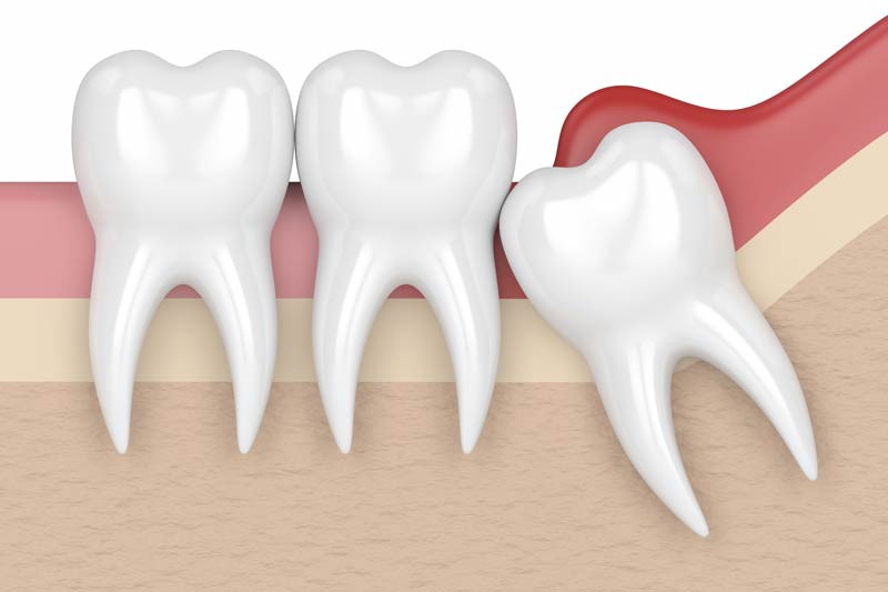 Emergency Dentist in El Cajon